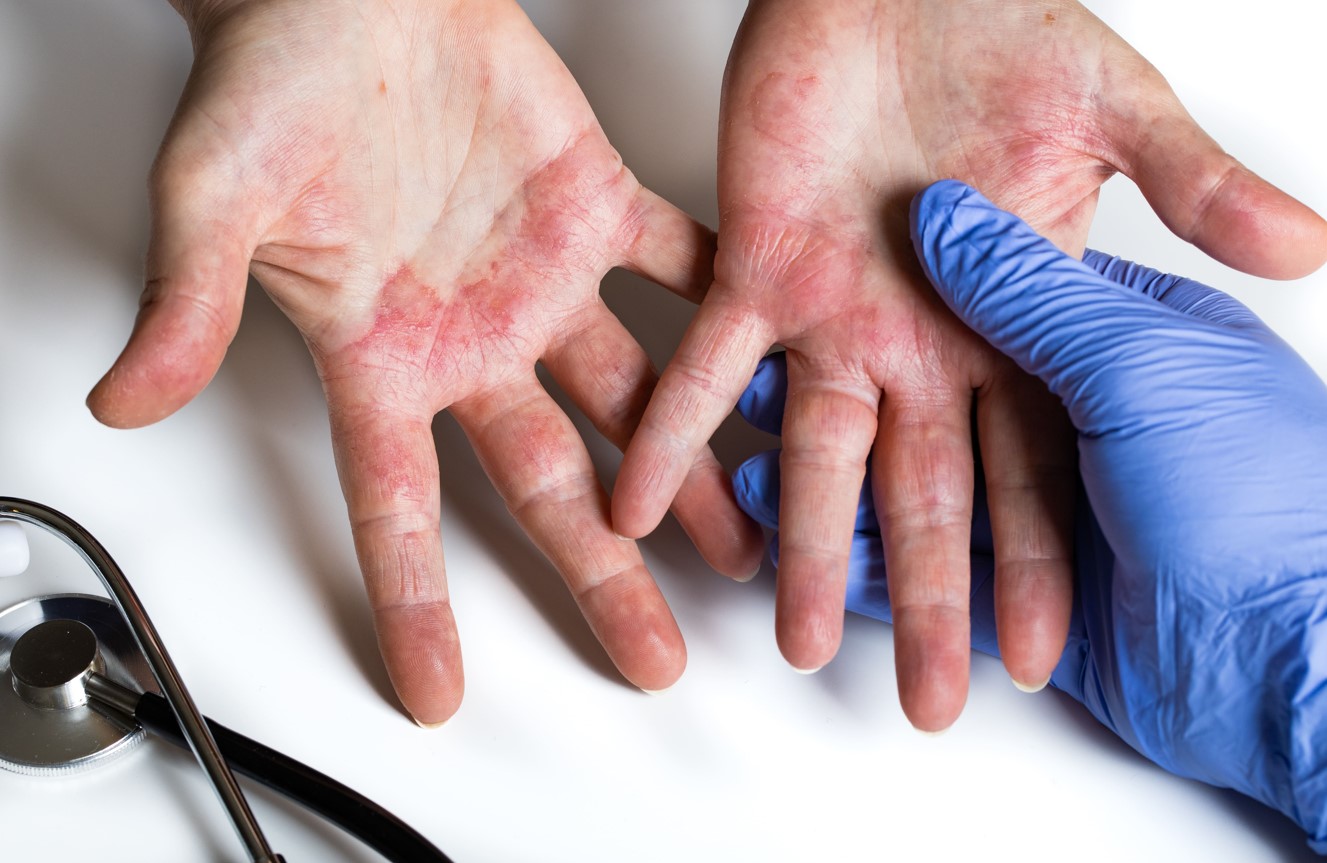 Manos limpias y piel sana: el reto para personas con dermatitis atópica